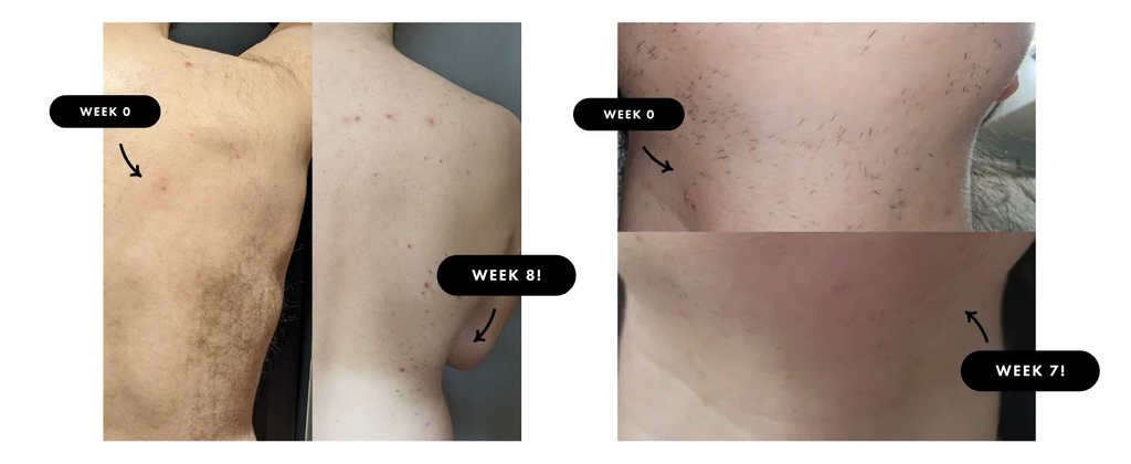 Professionele IPL-ontharing – Glade huid vanuit huis